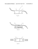 Universal laminoplasty implant diagram and image