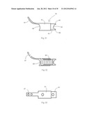 Universal laminoplasty implant diagram and image