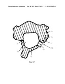 Universal laminoplasty implant diagram and image