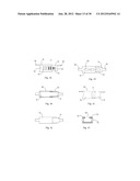 Universal laminoplasty implant diagram and image