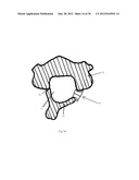 Universal laminoplasty implant diagram and image