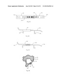 Universal laminoplasty implant diagram and image