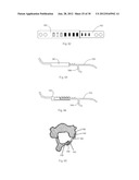 Universal laminoplasty implant diagram and image