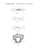 Universal laminoplasty implant diagram and image