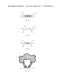 Universal laminoplasty implant diagram and image