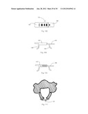 Universal laminoplasty implant diagram and image