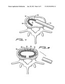 Spinal Implant And Method Of Use diagram and image