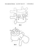 INTRADISCAL MOTION LIMITING MEMBER AND METHOD OF INSTALLATION THEREOF diagram and image