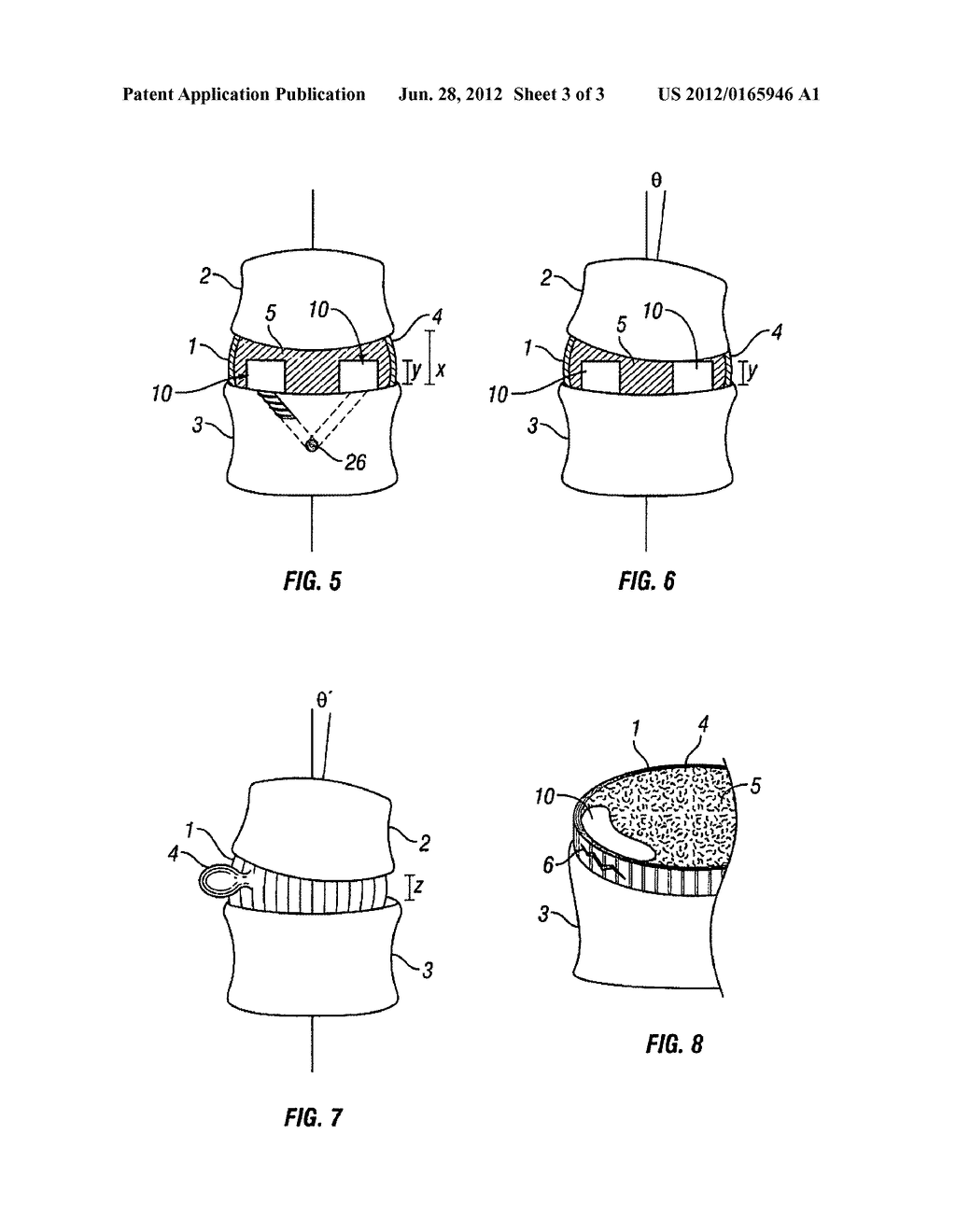 INTRADISCAL MOTION LIMITING MEMBER AND METHOD OF INSTALLATION THEREOF - diagram, schematic, and image 04