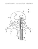 Disc Repair System diagram and image