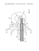 Disc Repair System diagram and image