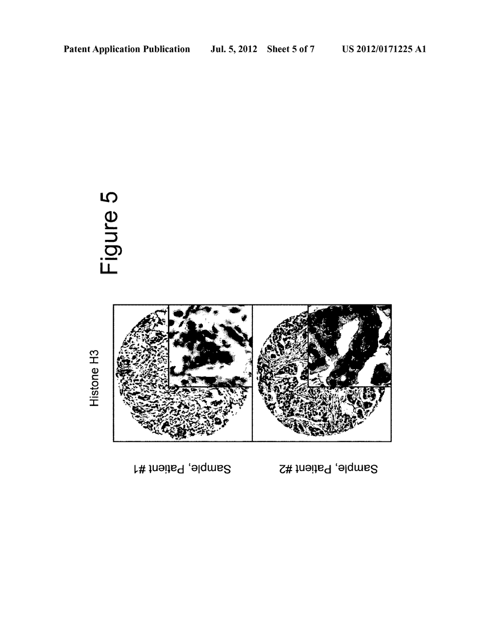 Diagnostic Method for Predicting the Risk of Cancer Recurrence Based on     Histone Macroh2A Isoforms - diagram, schematic, and image 06