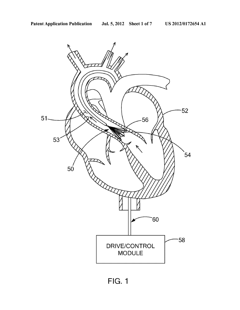 VENTRICULAR ASSIST DEVICE - diagram, schematic, and image 02