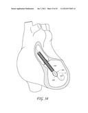 IMPELLER HOUSING FOR PERCUTANEOUS HEART PUMP diagram and image