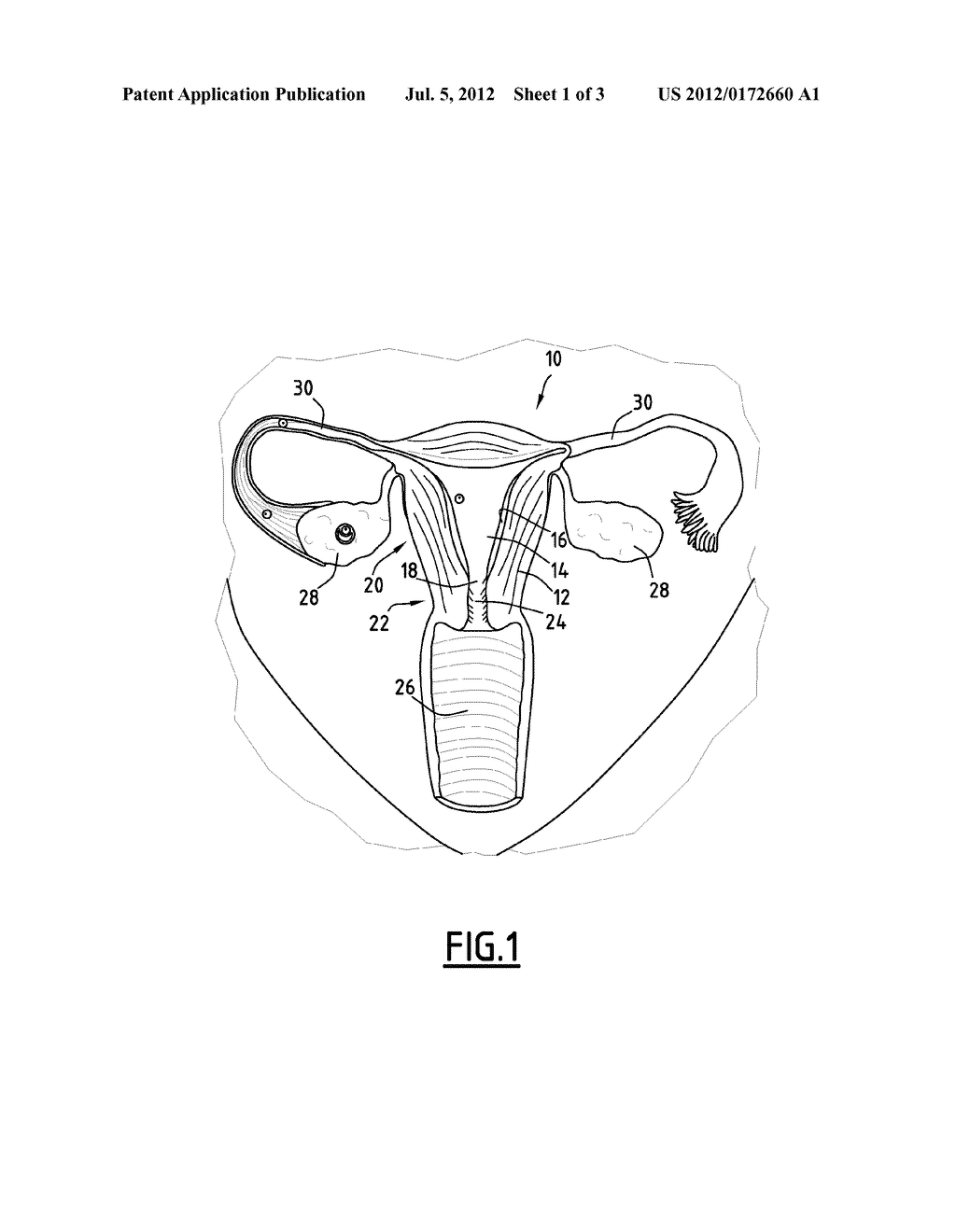 Catheter, In Particular for Implanting an Embryo in the Uterine Cavity of     a Human Being or Animal, and Corresponding Instrument - diagram, schematic, and image 02