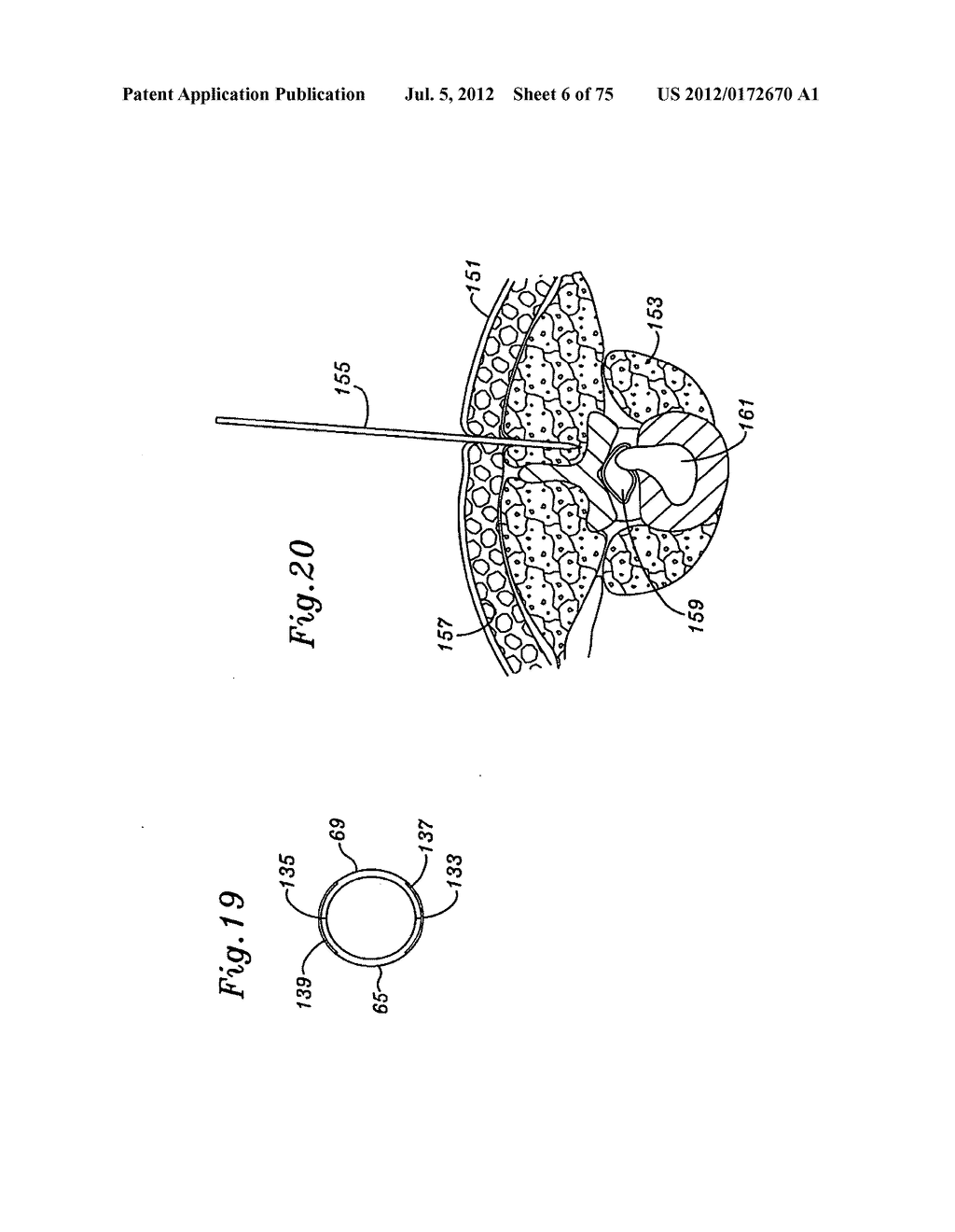 MINIMAL INCISION MAXIMAL ACCESS MIS SPINE INSTRUMENTATION AND METHOD - diagram, schematic, and image 07