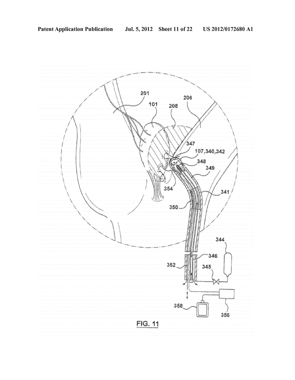 METHOD FOR SYMPATHETIC REBALANCING OF PATIENT - diagram, schematic, and image 12