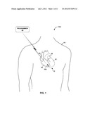 IMPLANTABLE MEDICAL DEVICE FIXATION diagram and image