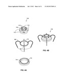 IMPLANTABLE MEDICAL DEVICE FIXATION diagram and image