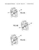 APPARATUS AND METHOD FOR NON-INVASIVE INTRACARDIAC ELECTROCARDIOGRAPHY     USING MPI diagram and image