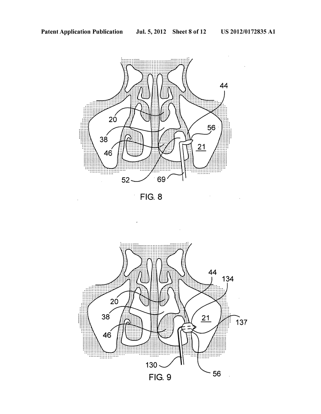 Multi-Conduit Balloon Catheter - diagram, schematic, and image 09