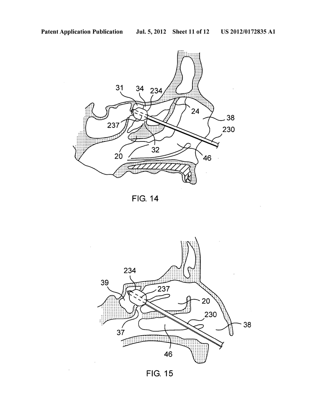 Multi-Conduit Balloon Catheter - diagram, schematic, and image 12