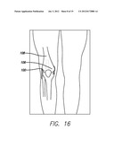 METHOD AND DEVICE FOR AMELIORATING JOINT CONDITIONS AND DISEASES diagram and image