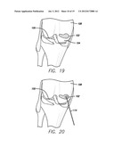 METHOD AND DEVICE FOR AMELIORATING JOINT CONDITIONS AND DISEASES diagram and image