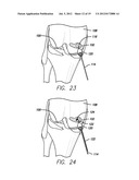 METHOD AND DEVICE FOR AMELIORATING JOINT CONDITIONS AND DISEASES diagram and image