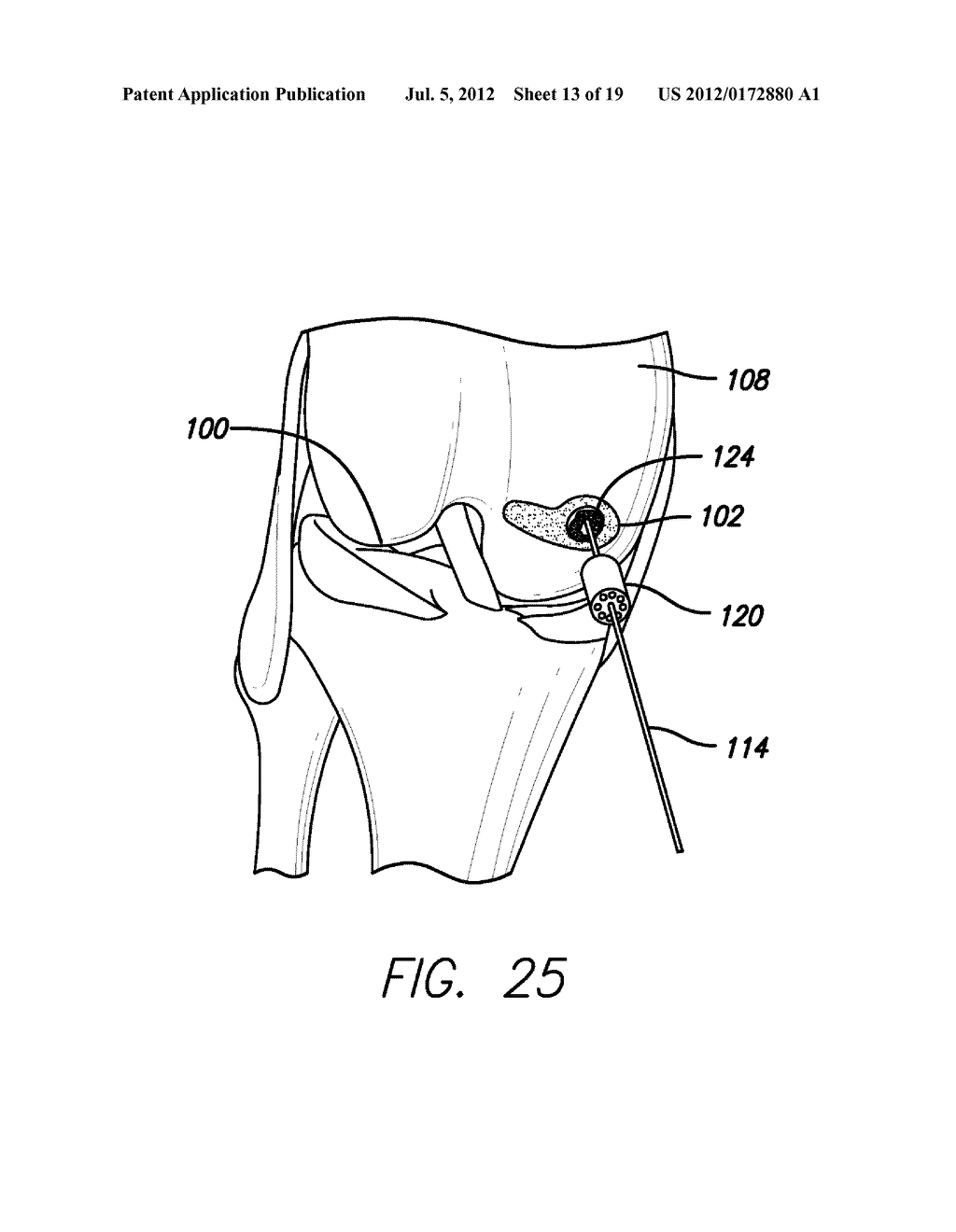 METHOD AND DEVICE FOR AMELIORATING JOINT CONDITIONS AND DISEASES - diagram, schematic, and image 14