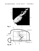 METHODS AND DEVICES FOR PATIENT-SPECIFIC ACETABULAR COMPONENT ALIGNMENT IN     TOTAL HIP ARTHROPLASTY diagram and image