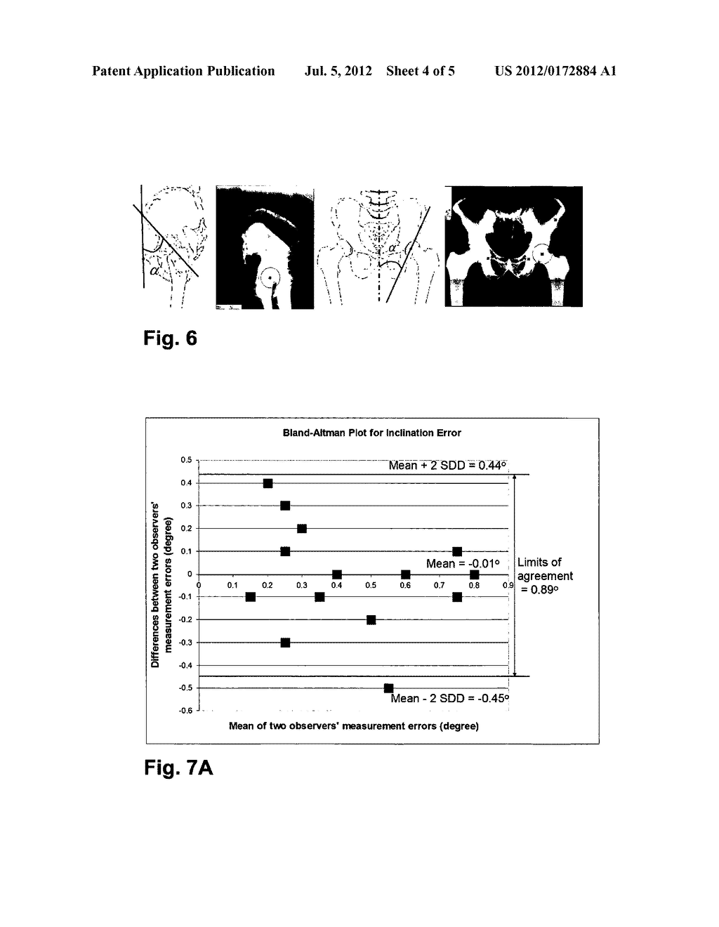 METHODS AND DEVICES FOR PATIENT-SPECIFIC ACETABULAR COMPONENT ALIGNMENT IN     TOTAL HIP ARTHROPLASTY - diagram, schematic, and image 05