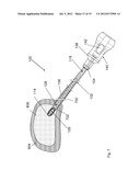 Tissue Removal Apparatus and Method of Manufacturing Same diagram and image