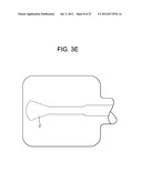 Expansion Screw Bone Tamp diagram and image