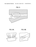 Expansion Screw Bone Tamp diagram and image