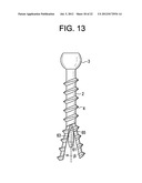 Expansion Screw Bone Tamp diagram and image