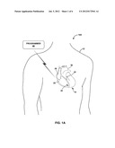 DISABLING AN IMPLANTABLE MEDICAL DEVICE diagram and image