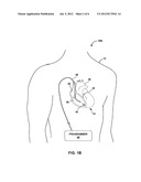 DISABLING AN IMPLANTABLE MEDICAL DEVICE diagram and image