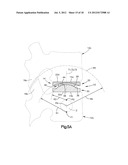 INTERVERTEBRAL IMPLANT WITH MULTIPLE RADII diagram and image