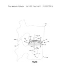 INTERVERTEBRAL IMPLANT WITH MULTIPLE RADII diagram and image