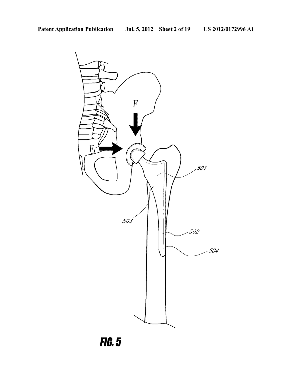 STEM FOR USE IN JOINT ARTHROPLASTY - diagram, schematic, and image 03