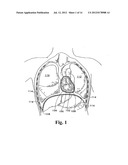 PERICARDIUM REINFORCING DEVICES AND METHODS FOR USING THEM diagram and image