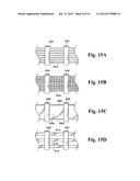 PERICARDIUM REINFORCING DEVICES AND METHODS FOR USING THEM diagram and image