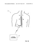 ASSOCIATING THERAPY ADJUSTMENTS WITH POSTURE STATES USING A STABILITY     TIMER diagram and image