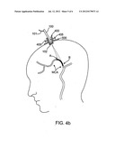 Ischemic Stroke Therapy diagram and image