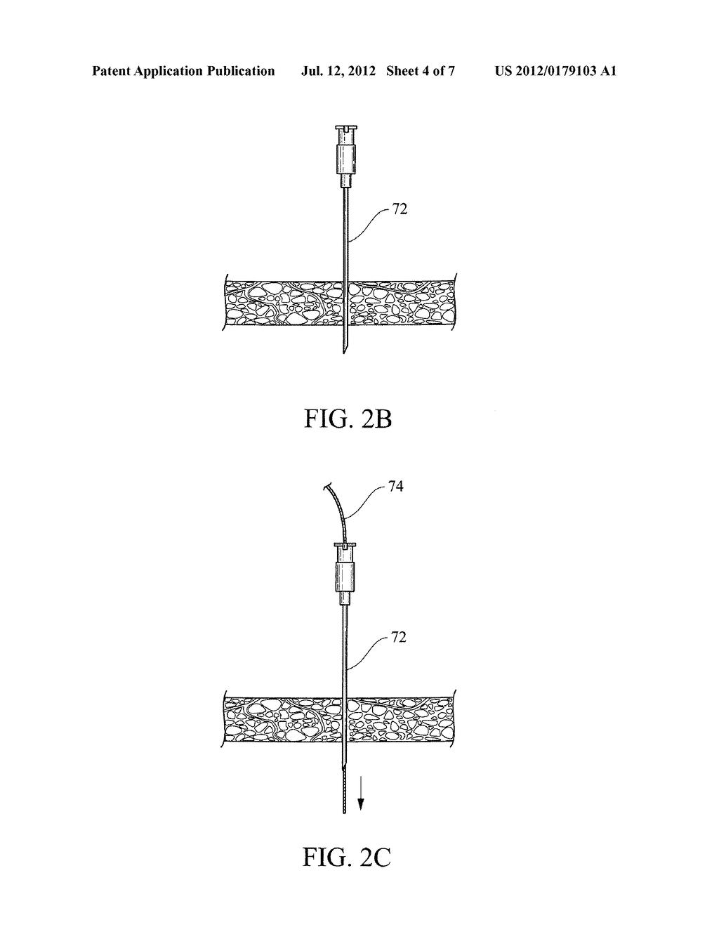 MULTI-LUMEN CATHETER WITH INCREASED FLOW AREA - diagram, schematic, and image 05