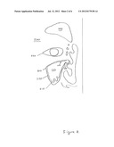 Sinus Ablation Devices, Methods, And Systems diagram and image