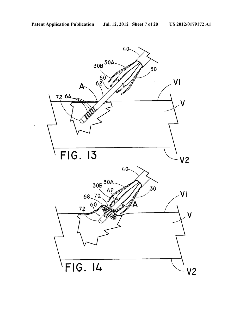 VESSEL CLOSURE DEVICE - diagram, schematic, and image 08