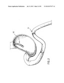 EQUIPMENT TO APPROXIMATE TISSUE PORTIONS, WHICH ARE INTENED TO FORM AN     ANASTOMOSIS, AND A METHOD FOR PERFORMING ANASTOMOSES IN TRACTS OF THE     DIGESTIVE TUBE diagram and image