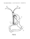 EQUIPMENT TO APPROXIMATE TISSUE PORTIONS, WHICH ARE INTENED TO FORM AN     ANASTOMOSIS, AND A METHOD FOR PERFORMING ANASTOMOSES IN TRACTS OF THE     DIGESTIVE TUBE diagram and image